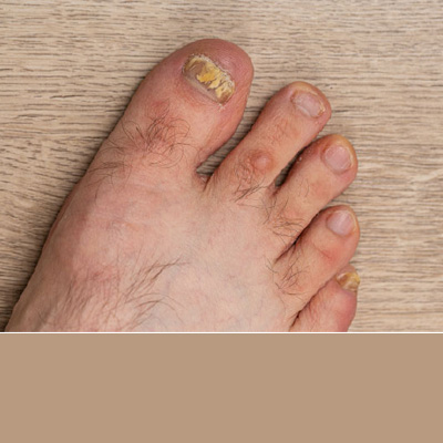 Hongos en pies y uñas