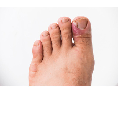 Uñas encarnadas
