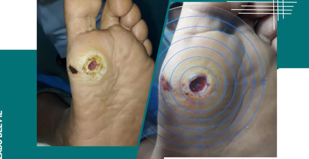 tratamiento pie diabetico guayaquil